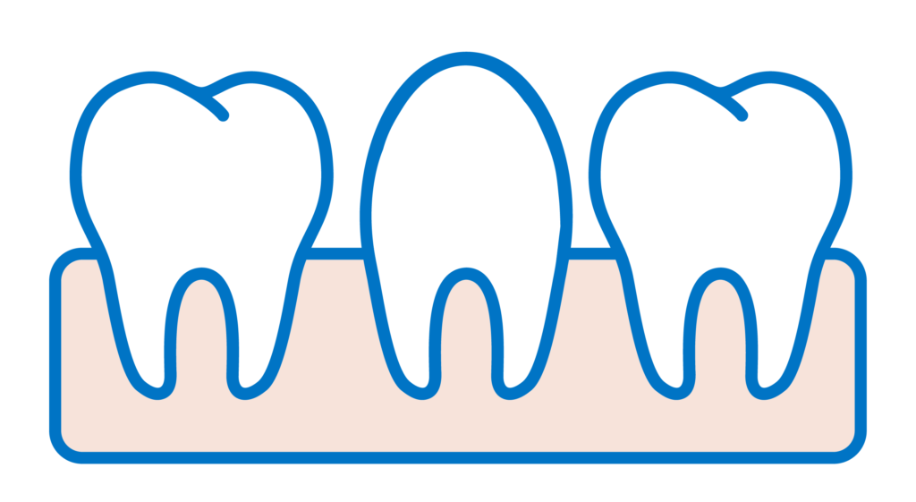 Faccette Dentali Conoidi