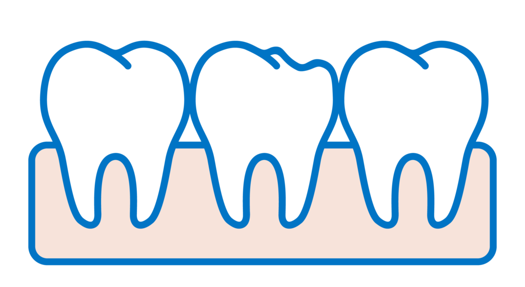 Faccette Dentali Denti rotti e fratturati