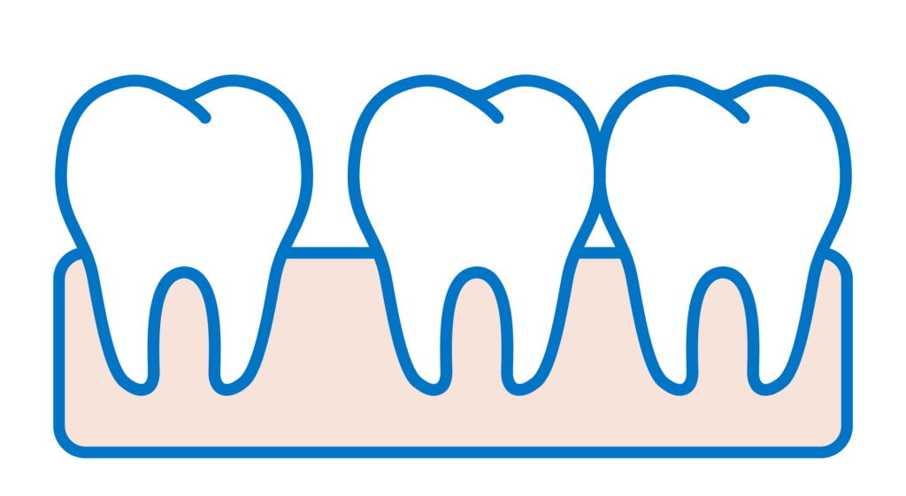 Faccette Dentali Diastemi
