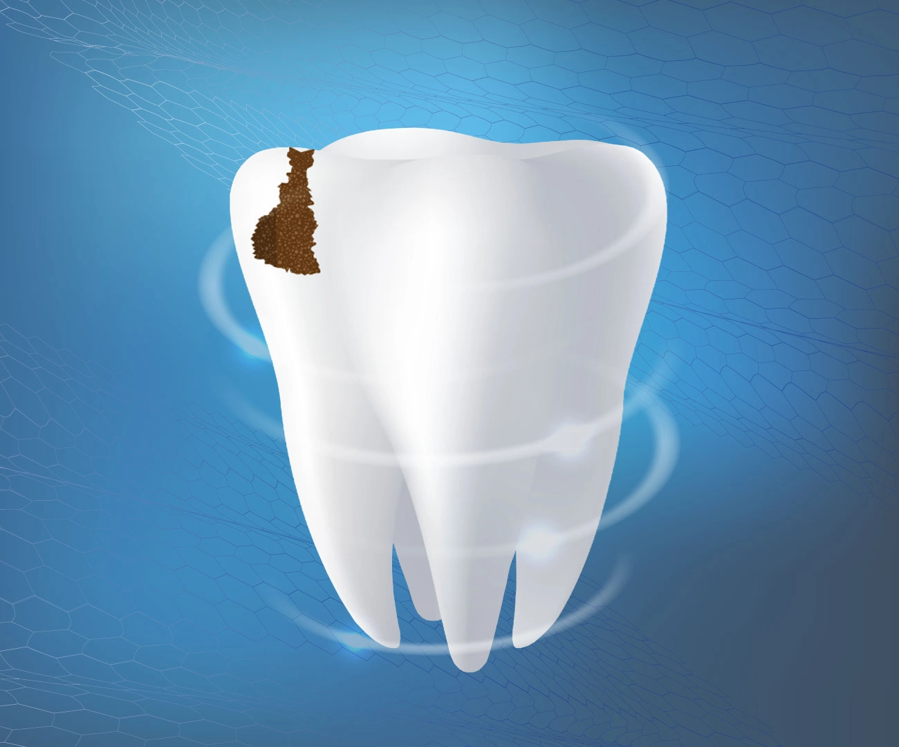 Odontoiatria Conservativa Carie Denti Dentista Prato My-Dentity