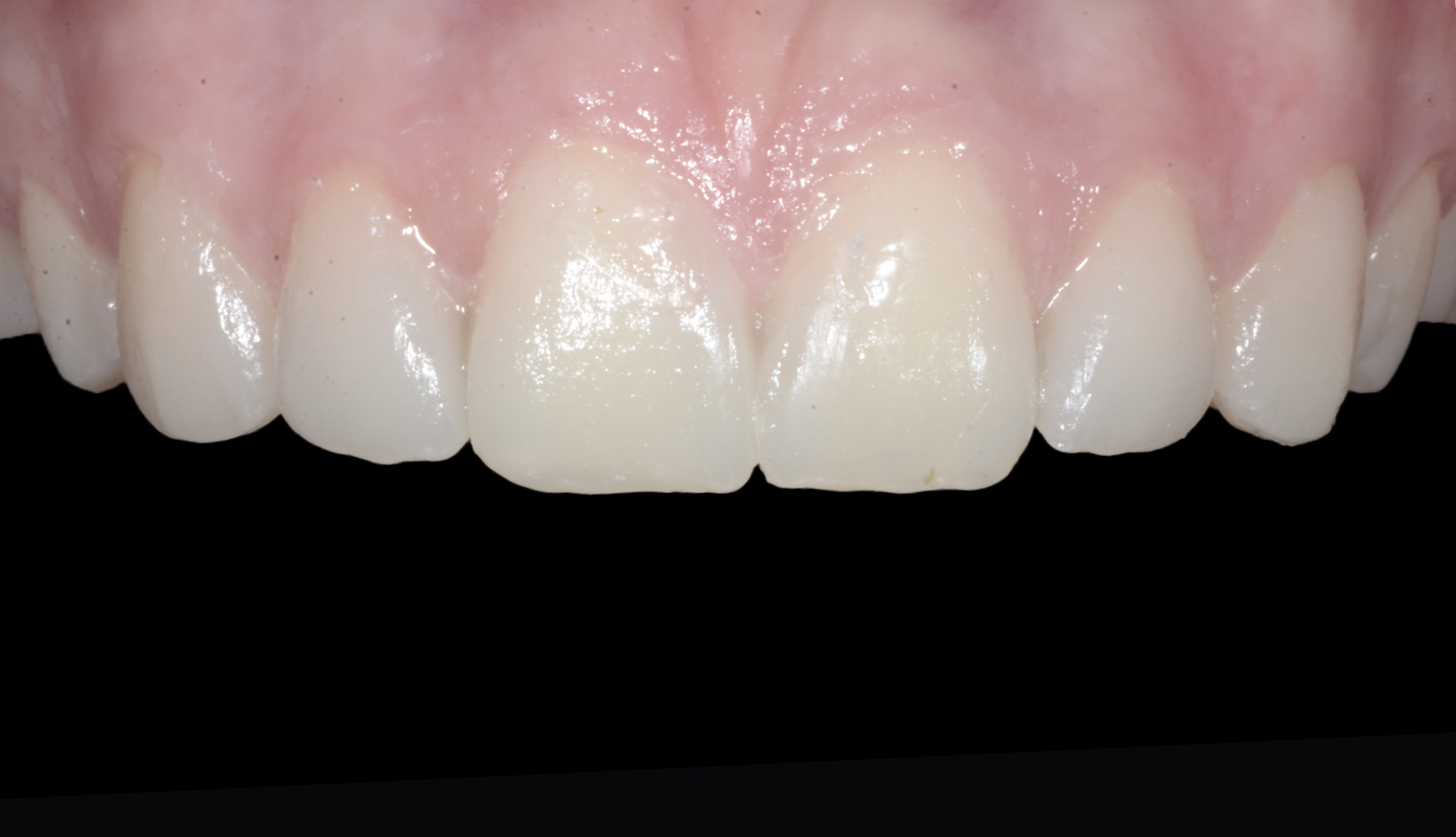 Denti Prima e Dopo Trattamento Dentista My-Dentity