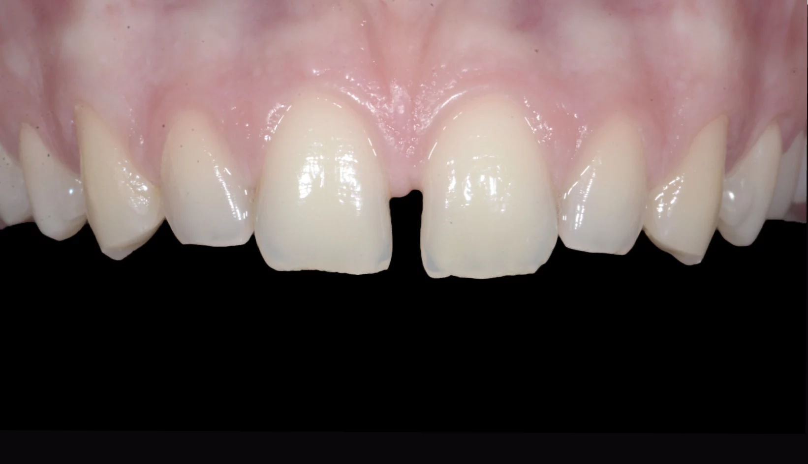 Denti Prima e Dopo Trattamento Dentista My-Dentity