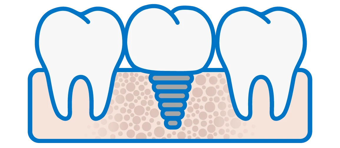 Chirurgia Rigenerativa Granulato Osseo Dentista Prato My-Dentity