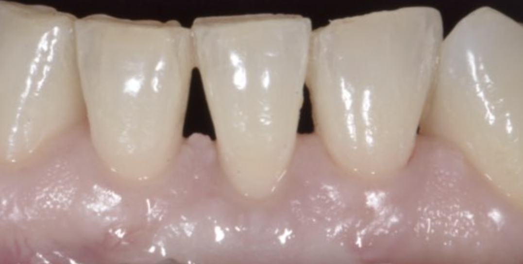 Chirurgia Muco Gengivale Dentista Prato My-Dentity