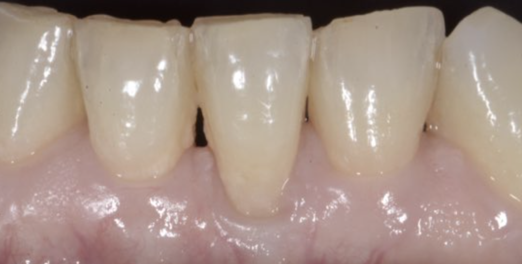 Chirurgia Muco Gengivale Dentista Prato My-Dentity