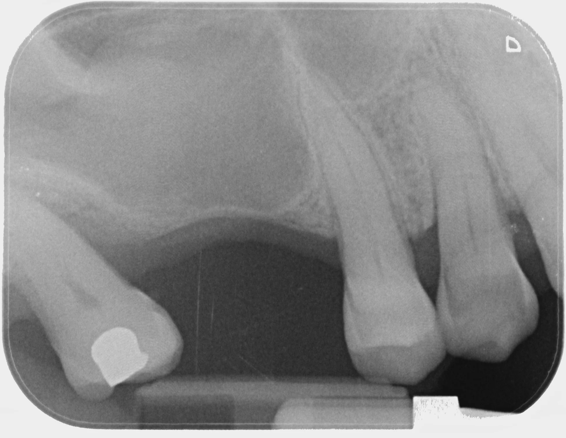 Chirurgia Rigenerativa Ossea Dentista Prato My-Dentity