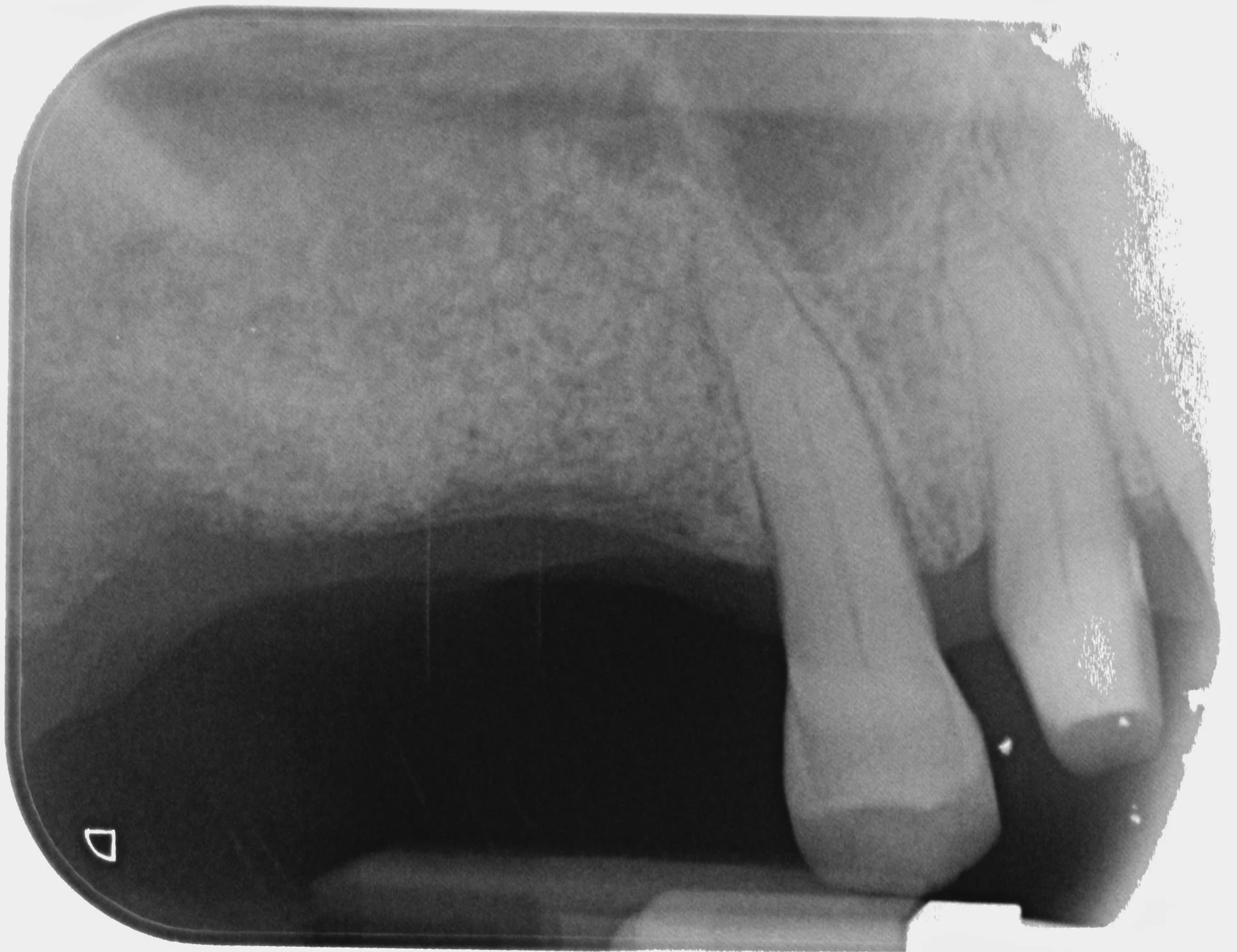 Chirurgia Rigenerativa Ossea Dentista Prato My-Dentity