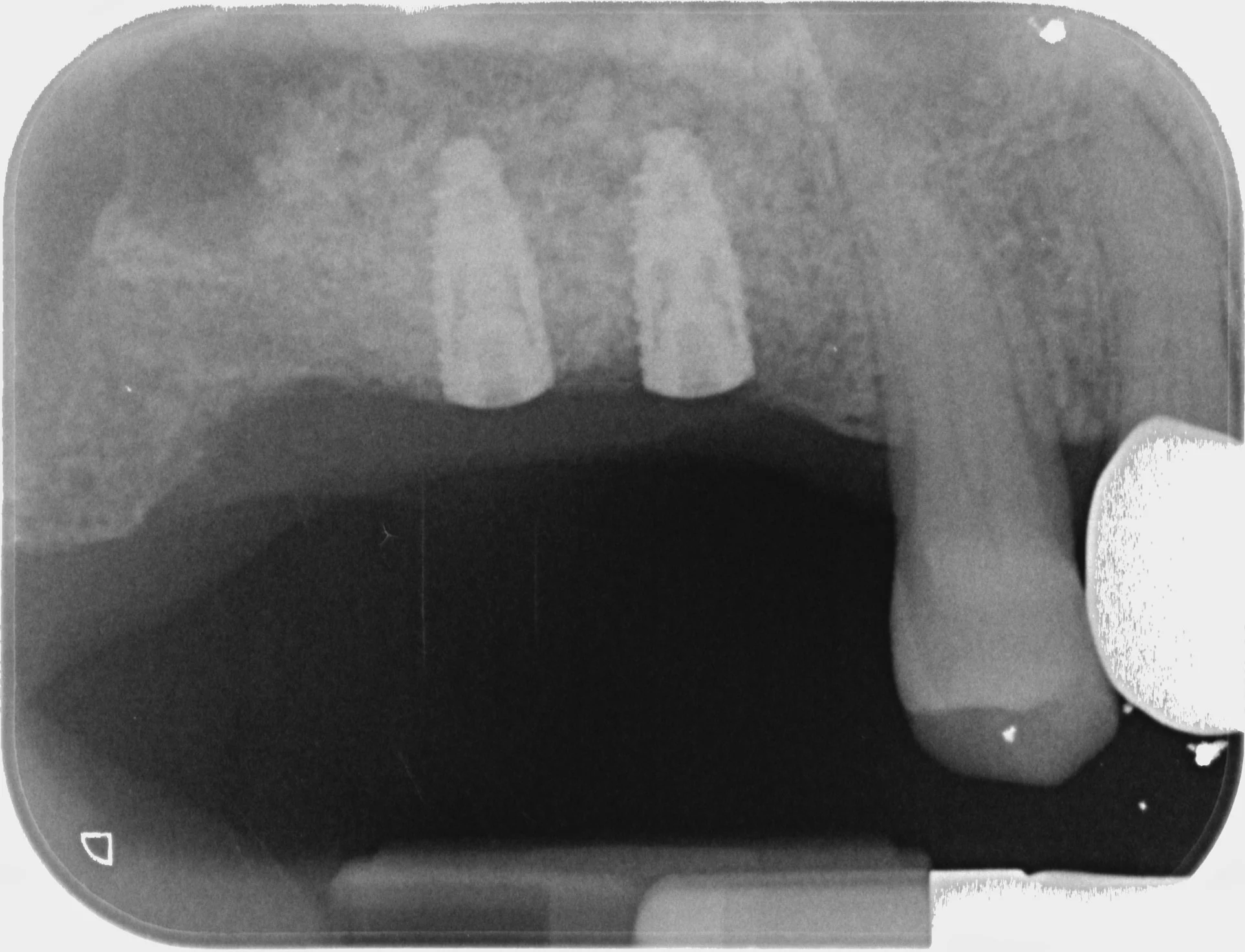 Chirurgia Rigenerativa Ossea Dentista Prato My-Dentity