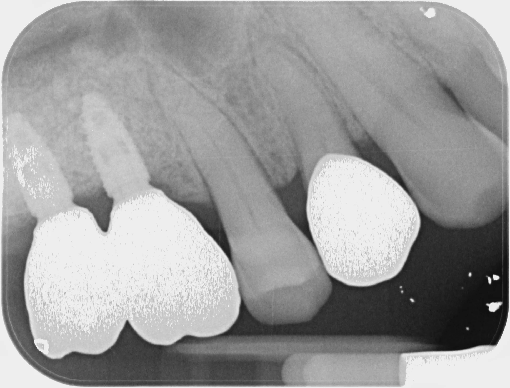 Chirurgia Rigenerativa Ossea Dentista Prato My-Dentity