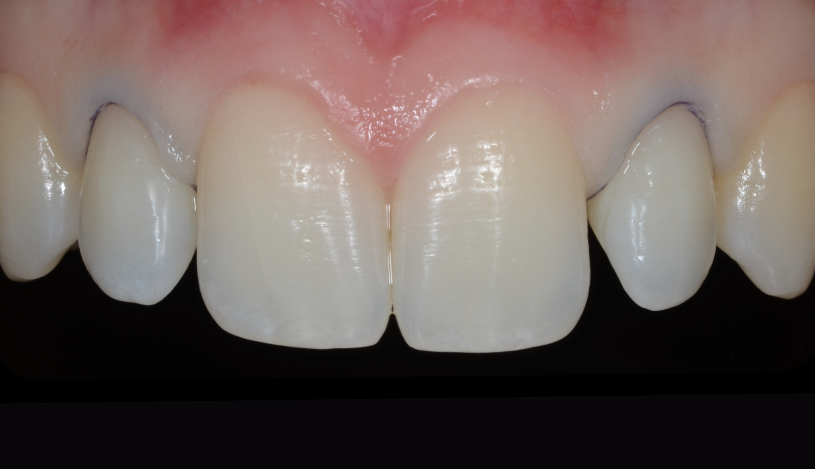 Faccette Dentali Conoidi Dentista Prato My-Dentity