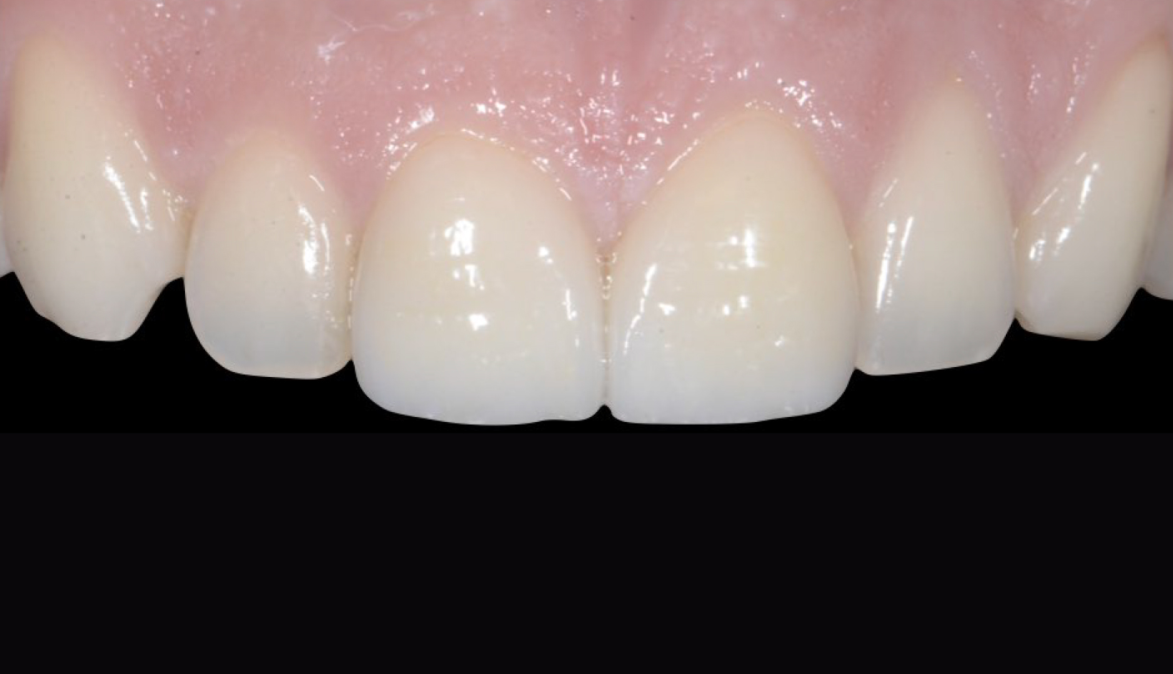Denti Prima e Dopo Trattamento Dentista My-Dentity