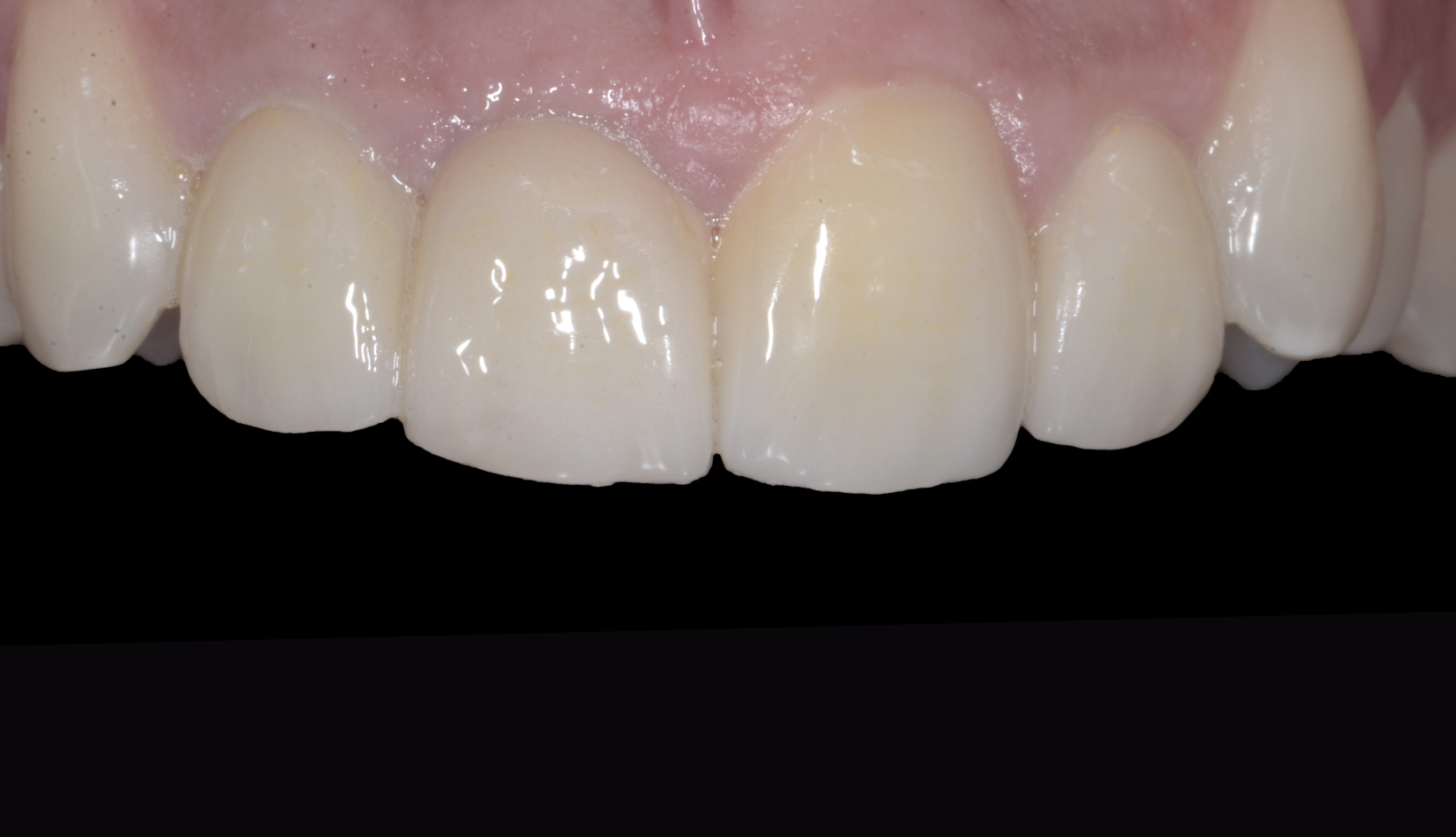 Denti Prima e Dopo Trattamento Dentista My-Dentity