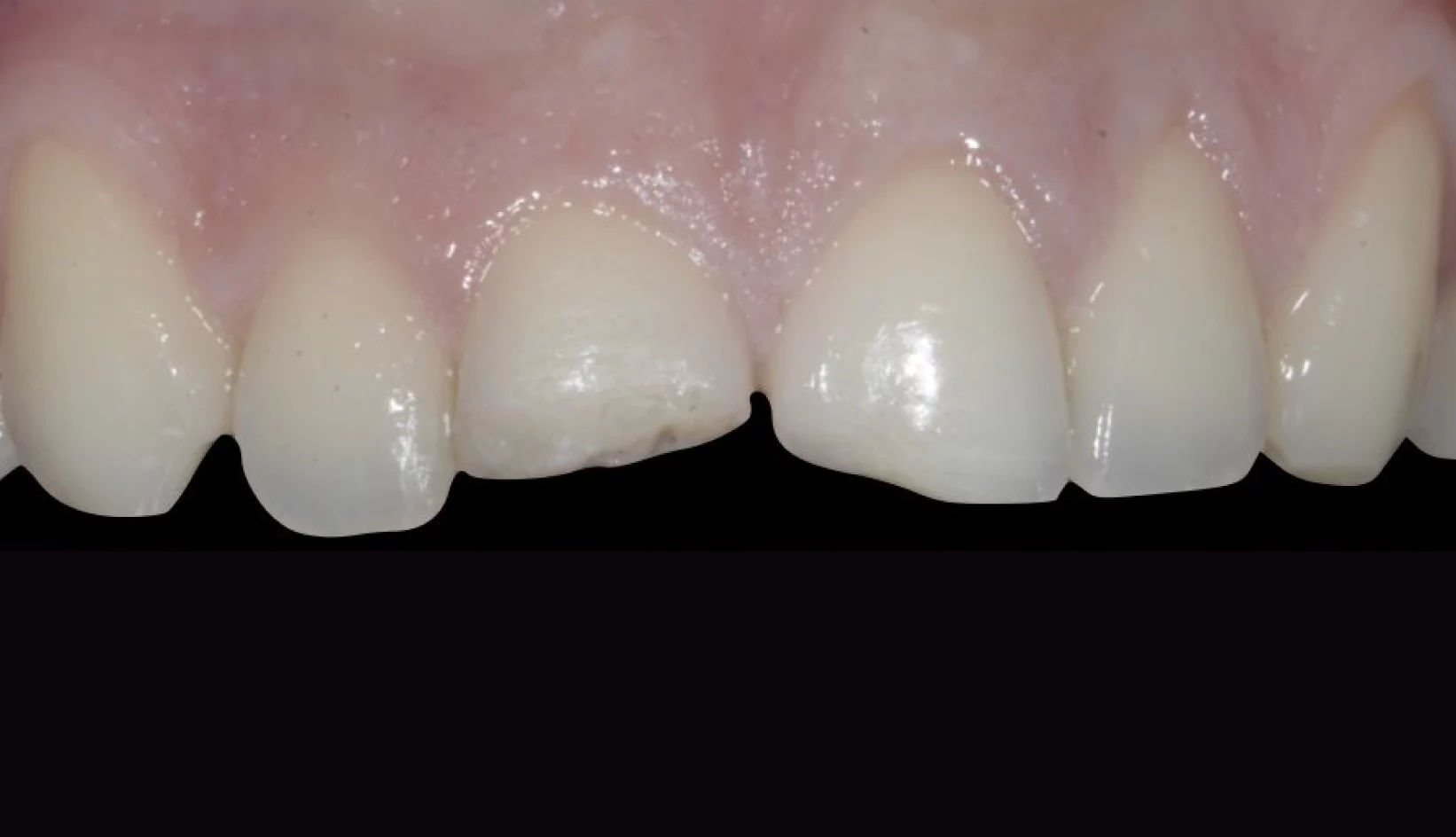 Denti Prima e Dopo Trattamento Dentista My-Dentity