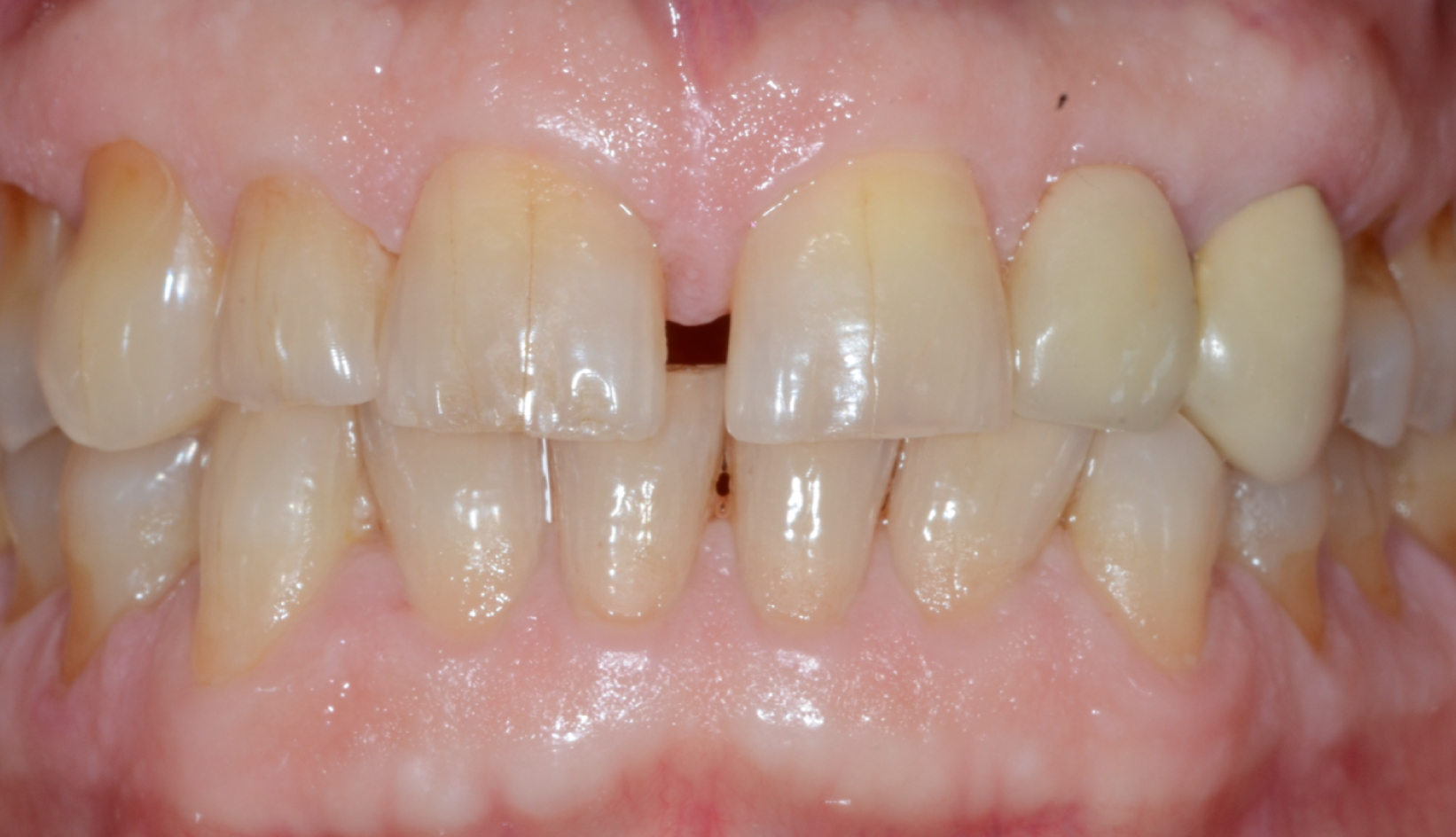 Diastema e Bruxismo Faccette Dentali Dentista Prato My-Dentity