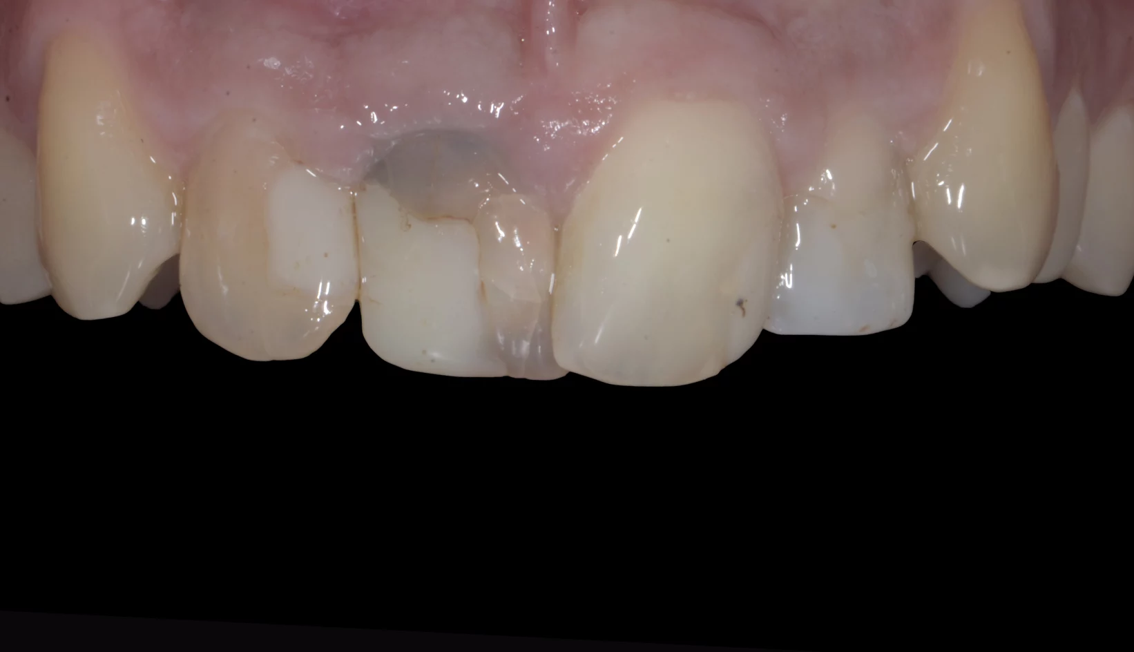 Denti Prima e Dopo Trattamento Dentista My-Dentity