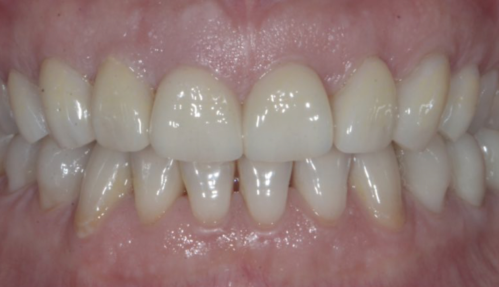 Diastema Denti, Faccette, Protesi Additiva, Sbiancamento Dentista Prato My-Dentity