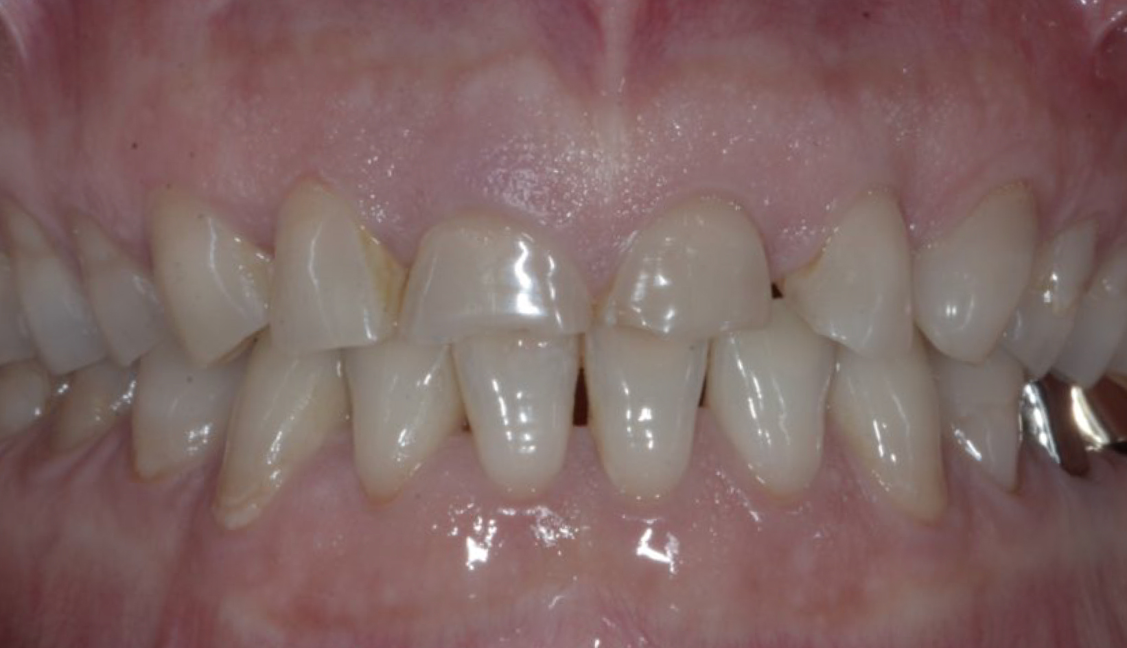 Diastema Denti, Faccette, Protesi Additiva, Sbiancamento Dentista Prato My-Dentity