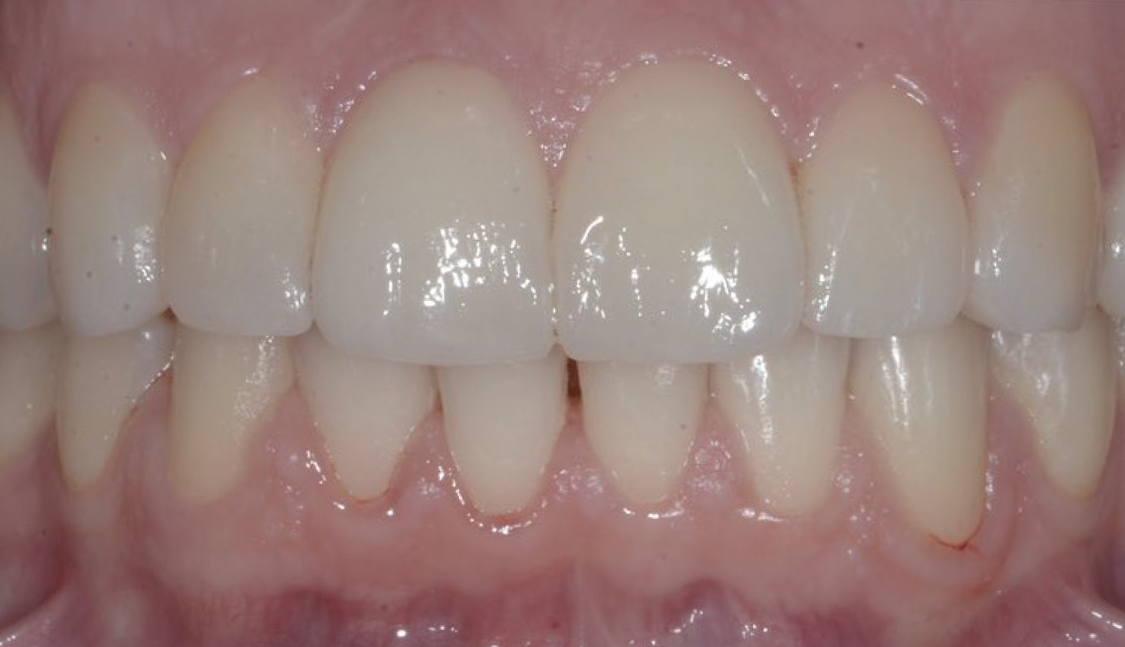 Faccette Dentali Dentista Prato My-Dentity