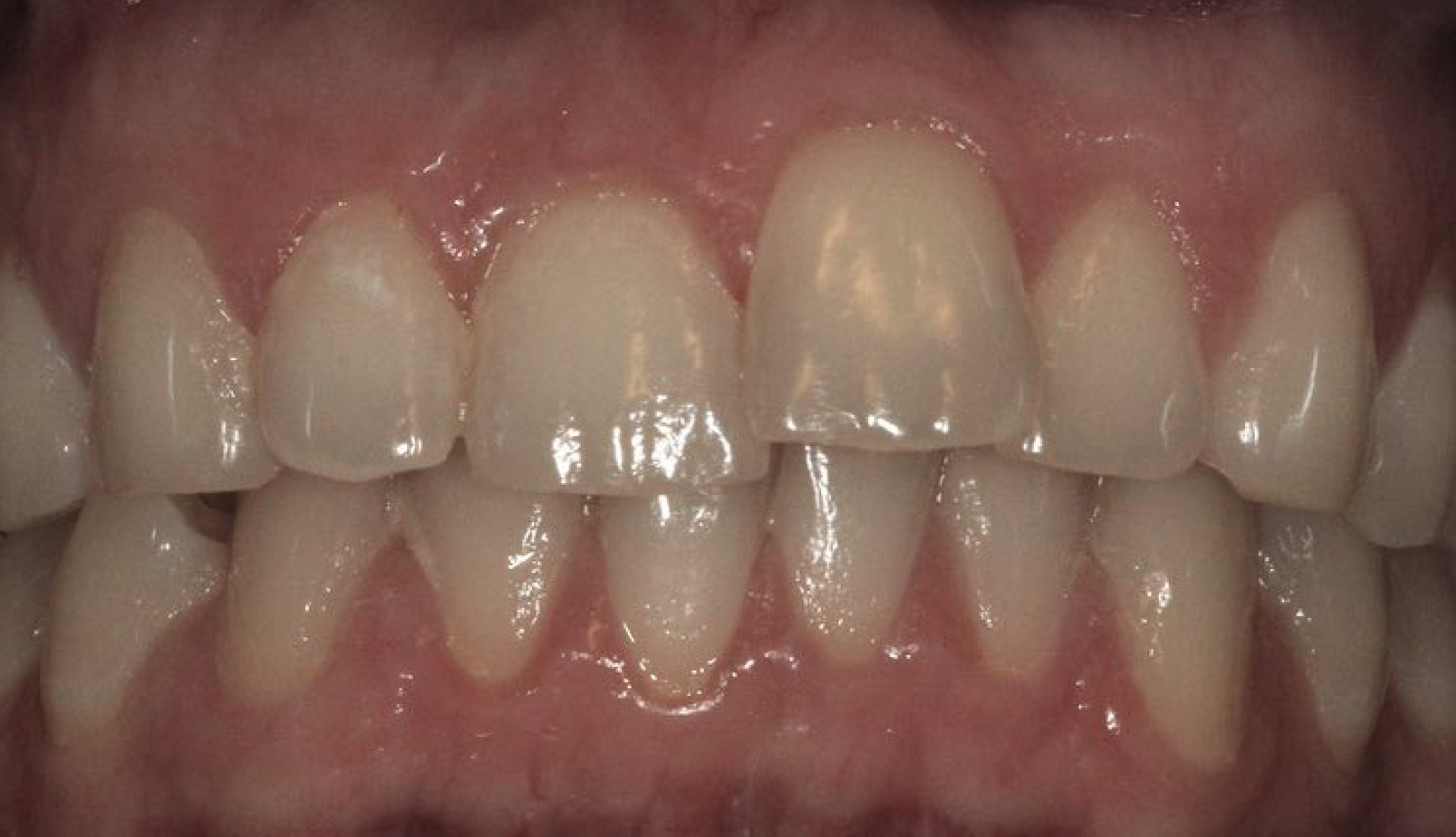 Faccette Dentali Dentista Prato My-Dentity