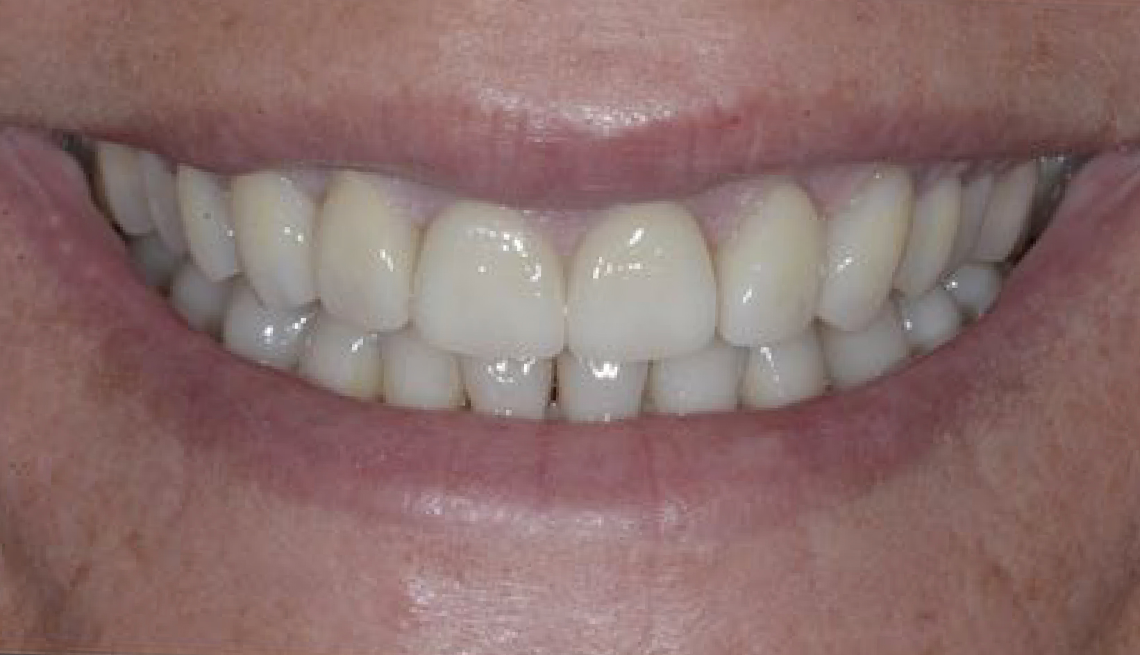 Protesi Additiva Dentista Prato My-Dentity