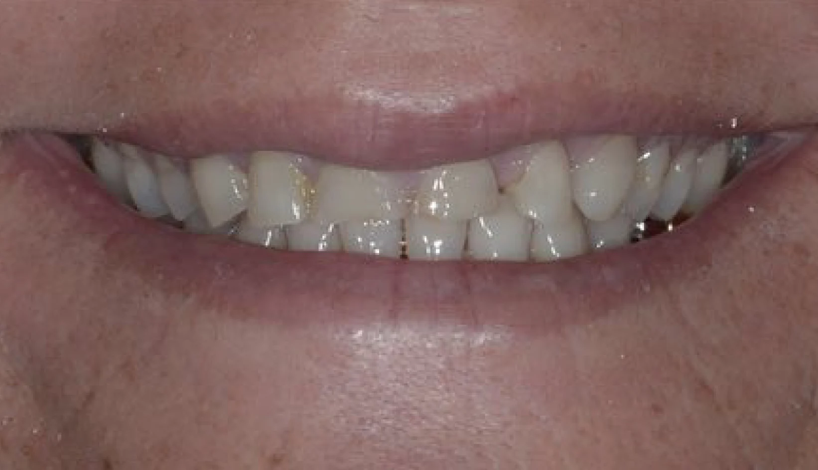 Protesi Additiva Dentista Prato My-Dentity