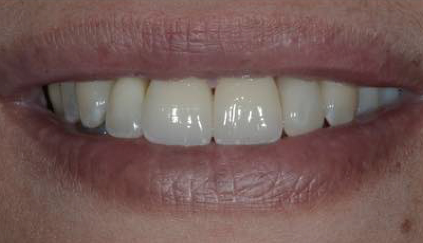 Protesi su Dente Naturale Conservativa Dentista Prato My-Dentity