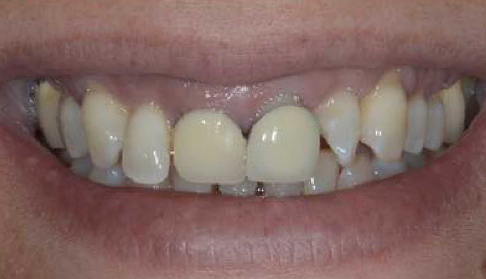 Protesi su Dente Naturale Conservativa Dentista Prato My-Dentity