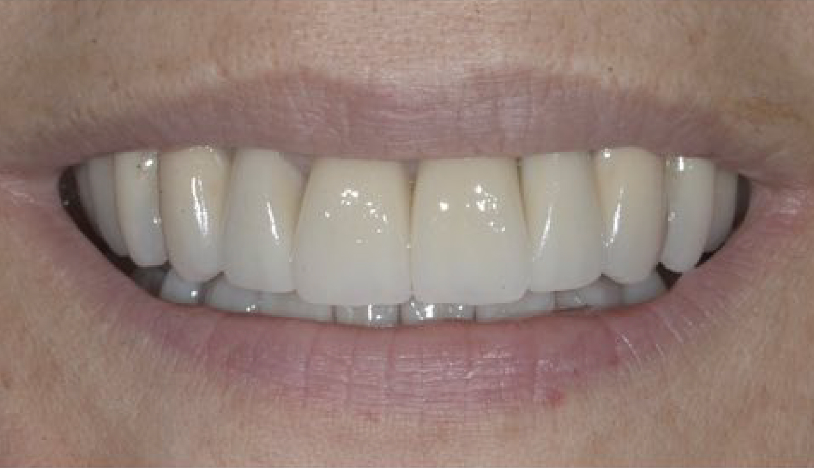 Protesi su Dente Naturale Dentista Prato My-Dentity