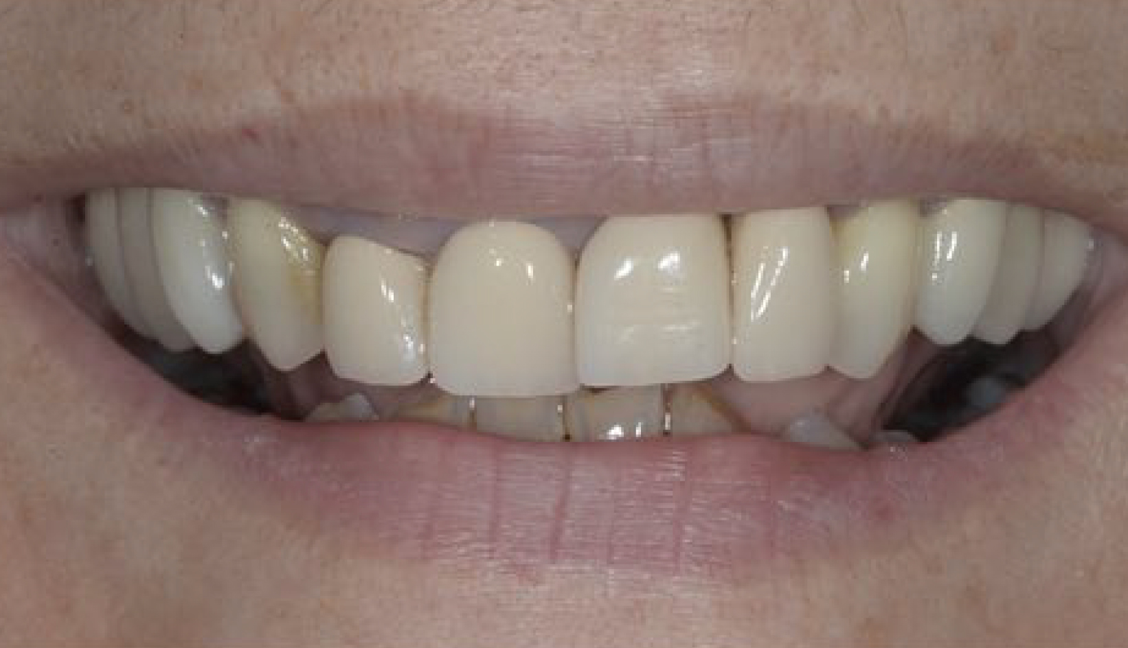Protesi su Dente Naturale Dentista Prato My-Dentity