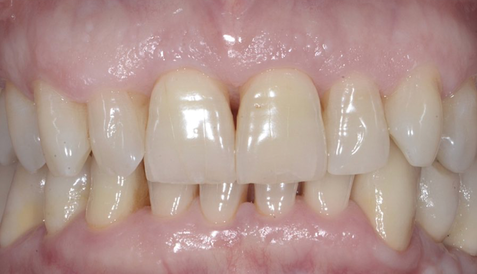 Protesi su Dente e Impianti Dentista Prato My-Dentity