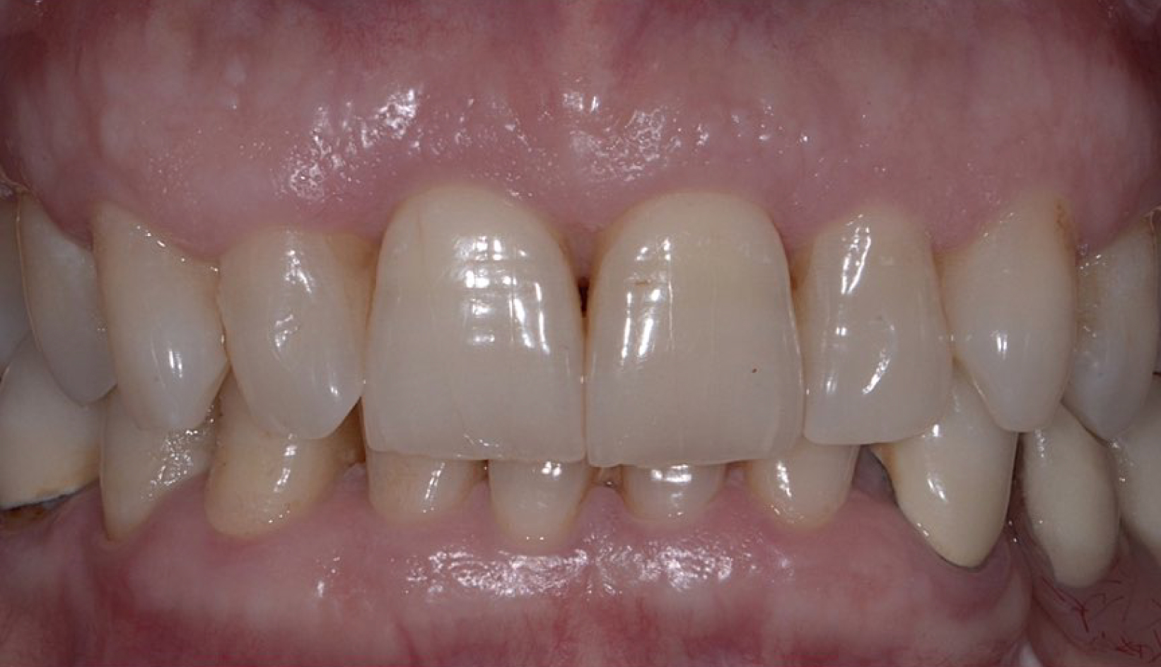 Protesi su Dente e Impianti Dentista Prato My-Dentity
