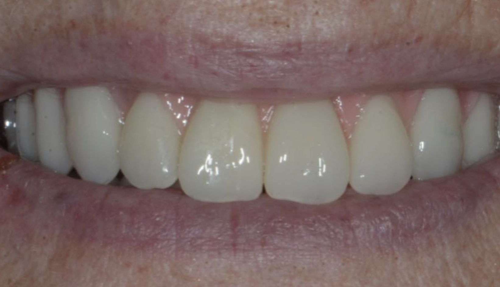 Protesi Denti su Impianti Dentista Prato My-Dentity