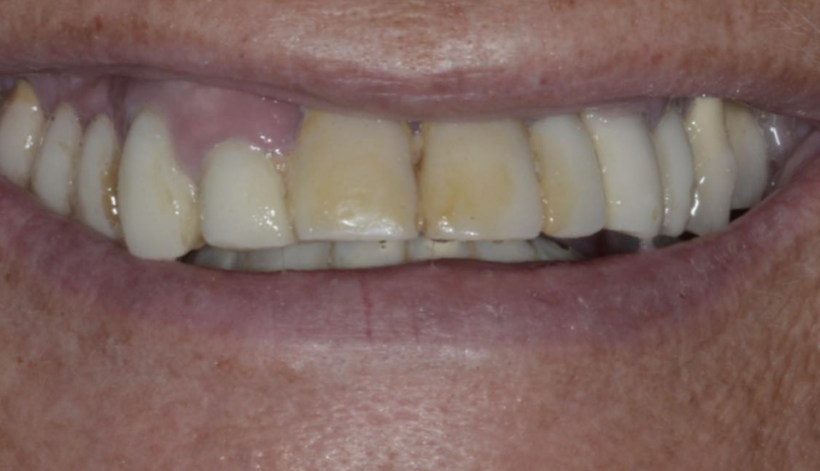 Protesi Denti su Impianti Dentista Prato My-Dentity