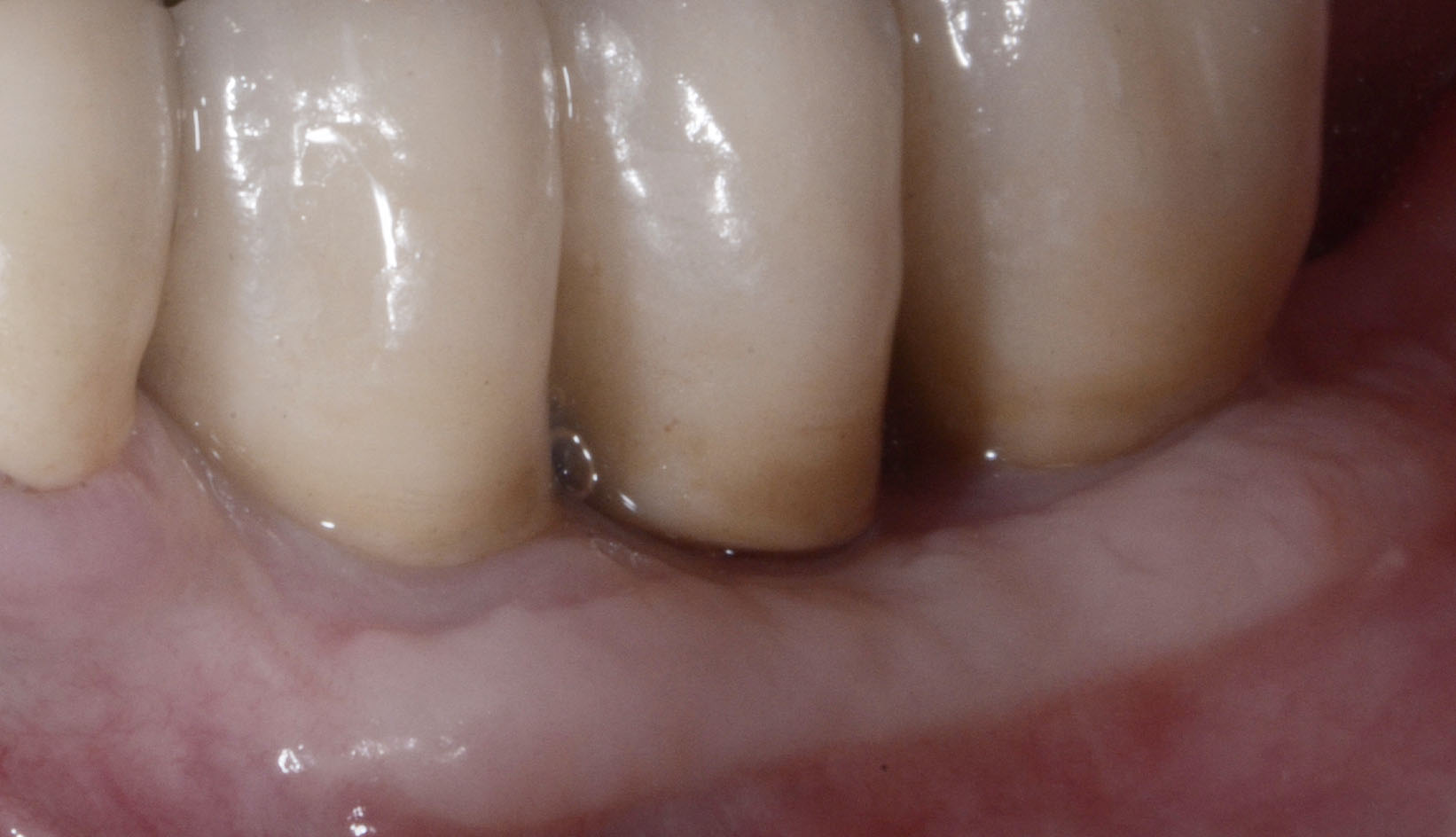 Chirurgia Muco Gengivale Dentista Prato My-Dentity