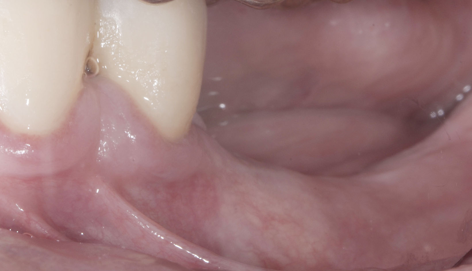 Chirurgia Muco Gengivale Dentista Prato My-Dentity