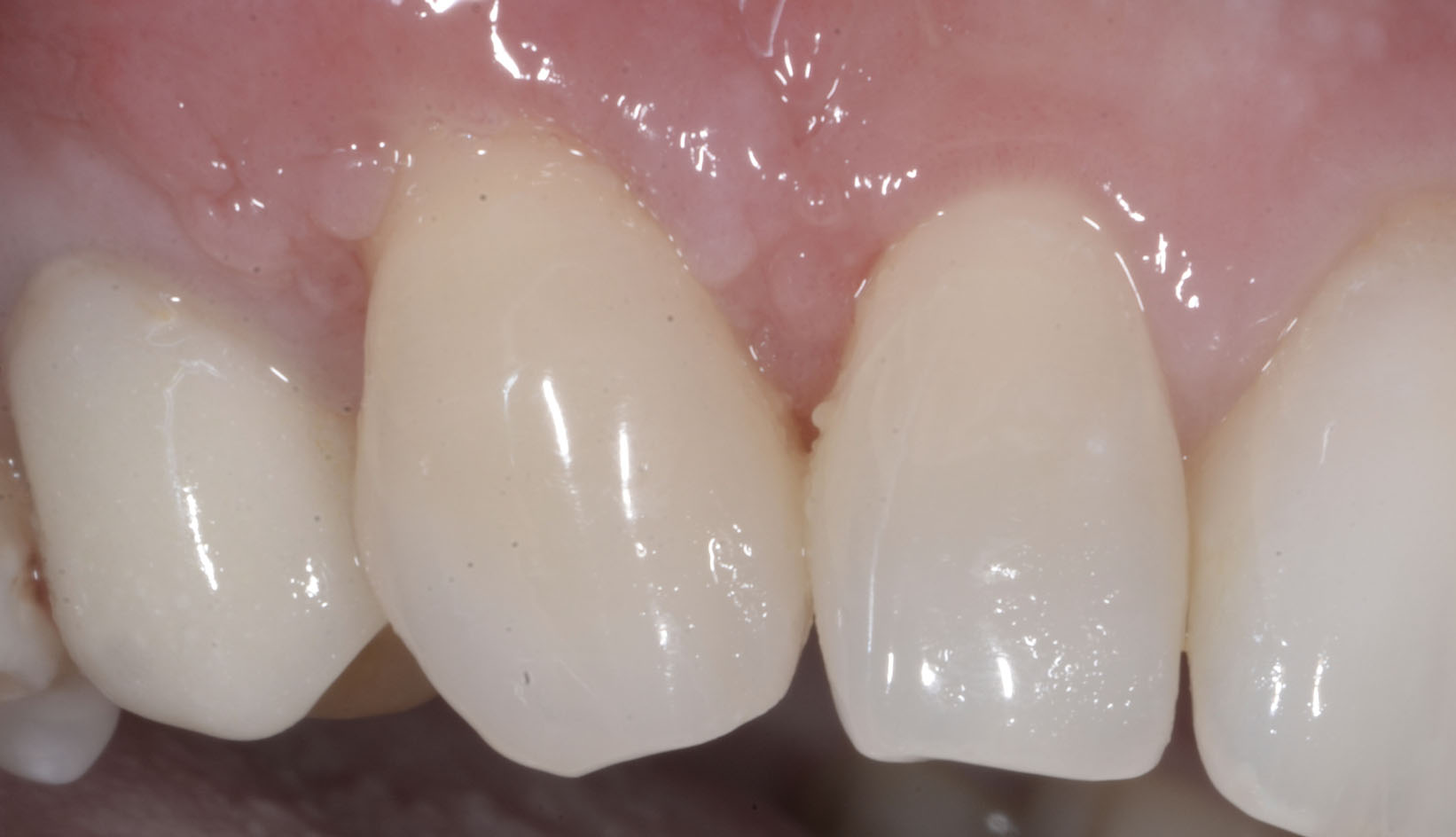 Chirurgia Muco Gengivale Dentista Prato My-Dentity