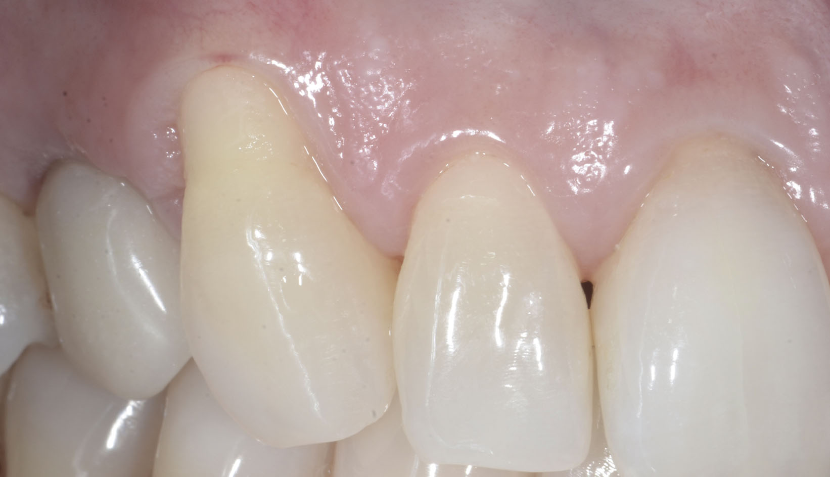 Chirurgia Muco Gengivale Dentista Prato My-Dentity