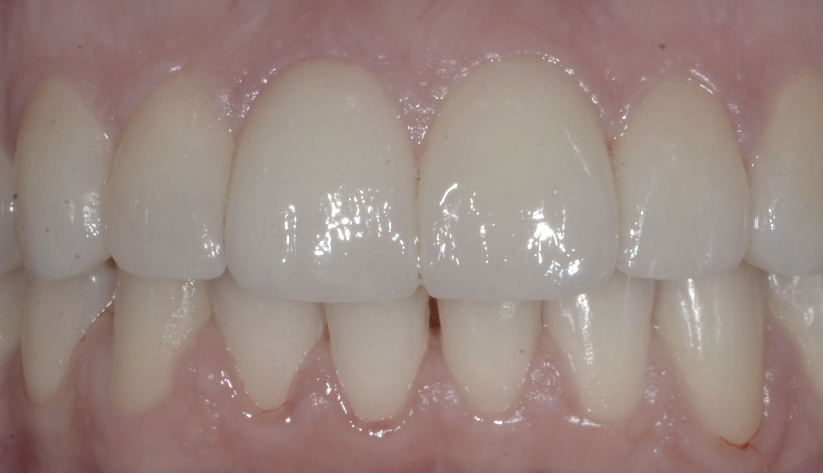 Faccette Dentali Dentista Prato My-Dentity