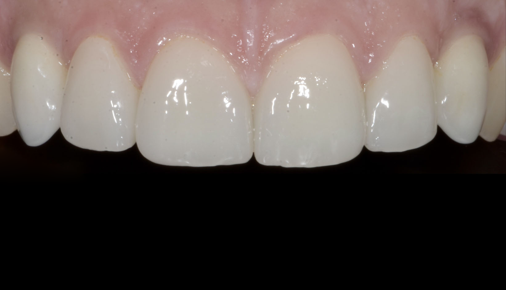 Faccette Dentali Dentista Prato My-Dentity