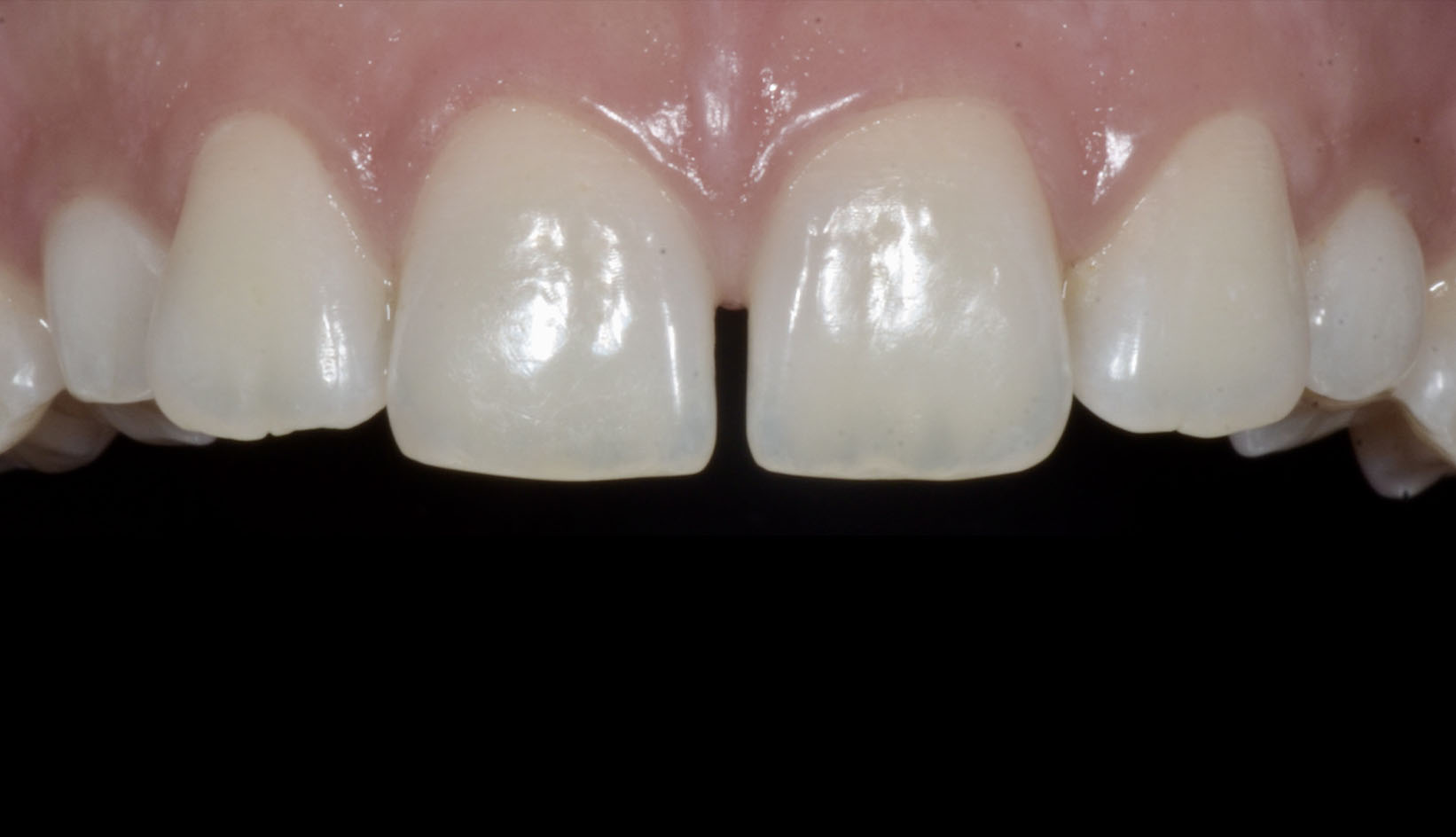 Faccette Dentali Dentista Prato My-Dentity
