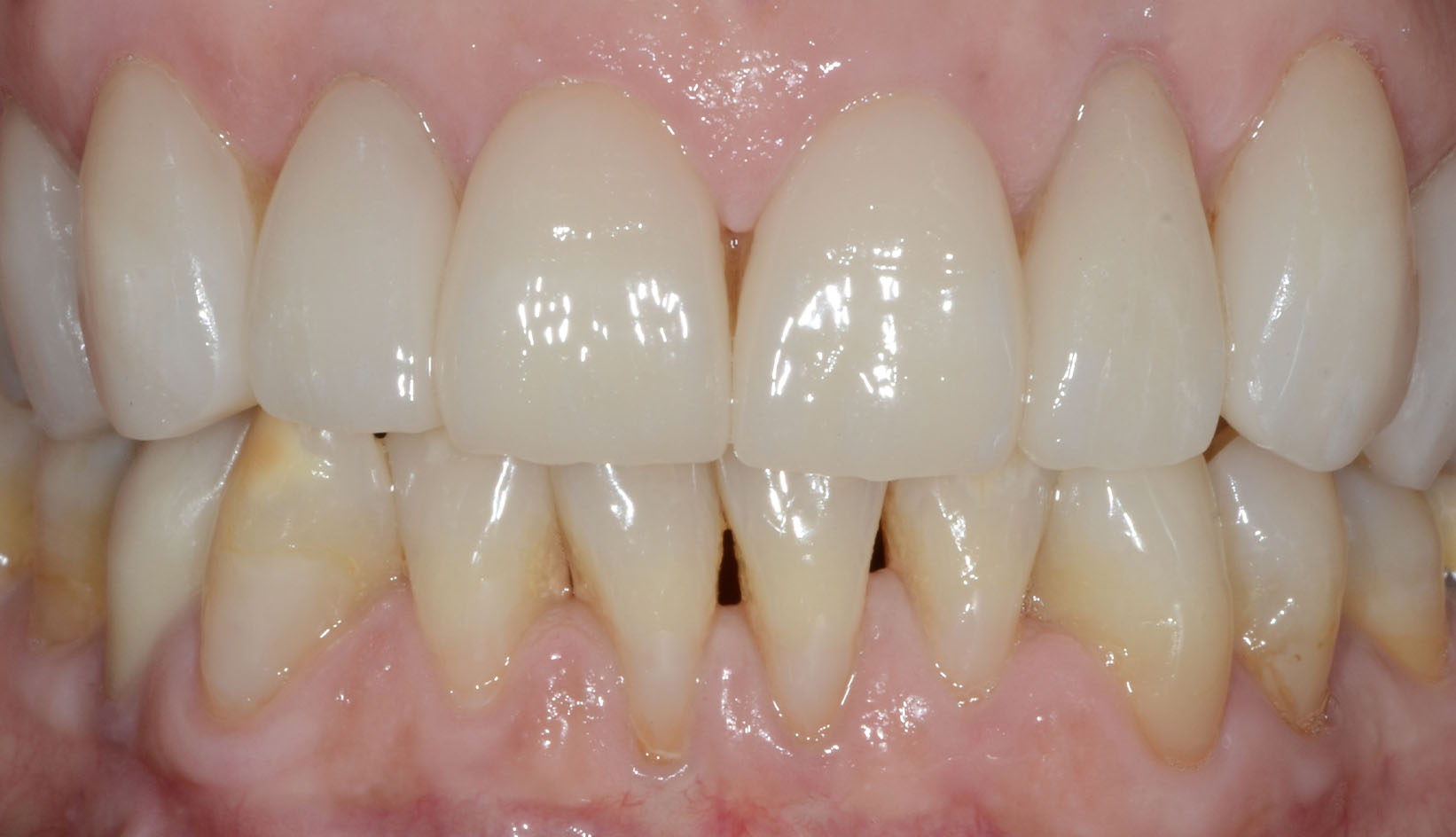 Faccette Dentali Dentista Prato My-Dentity