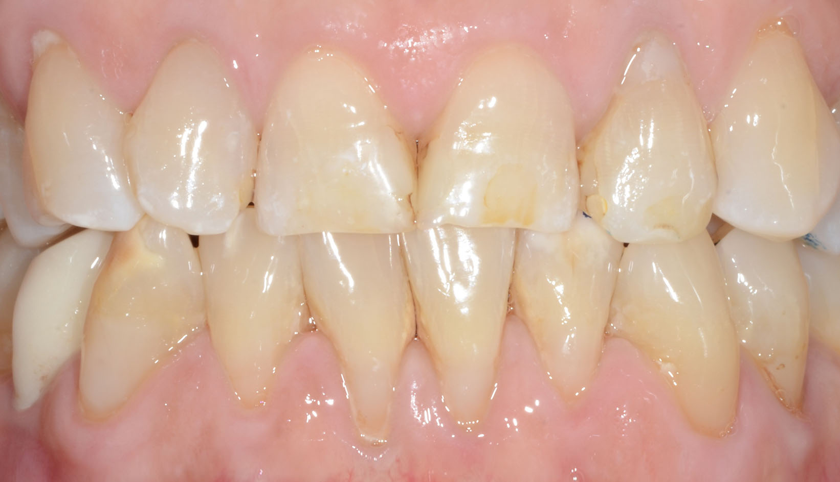 Faccette Dentali Dentista Prato My-Dentity