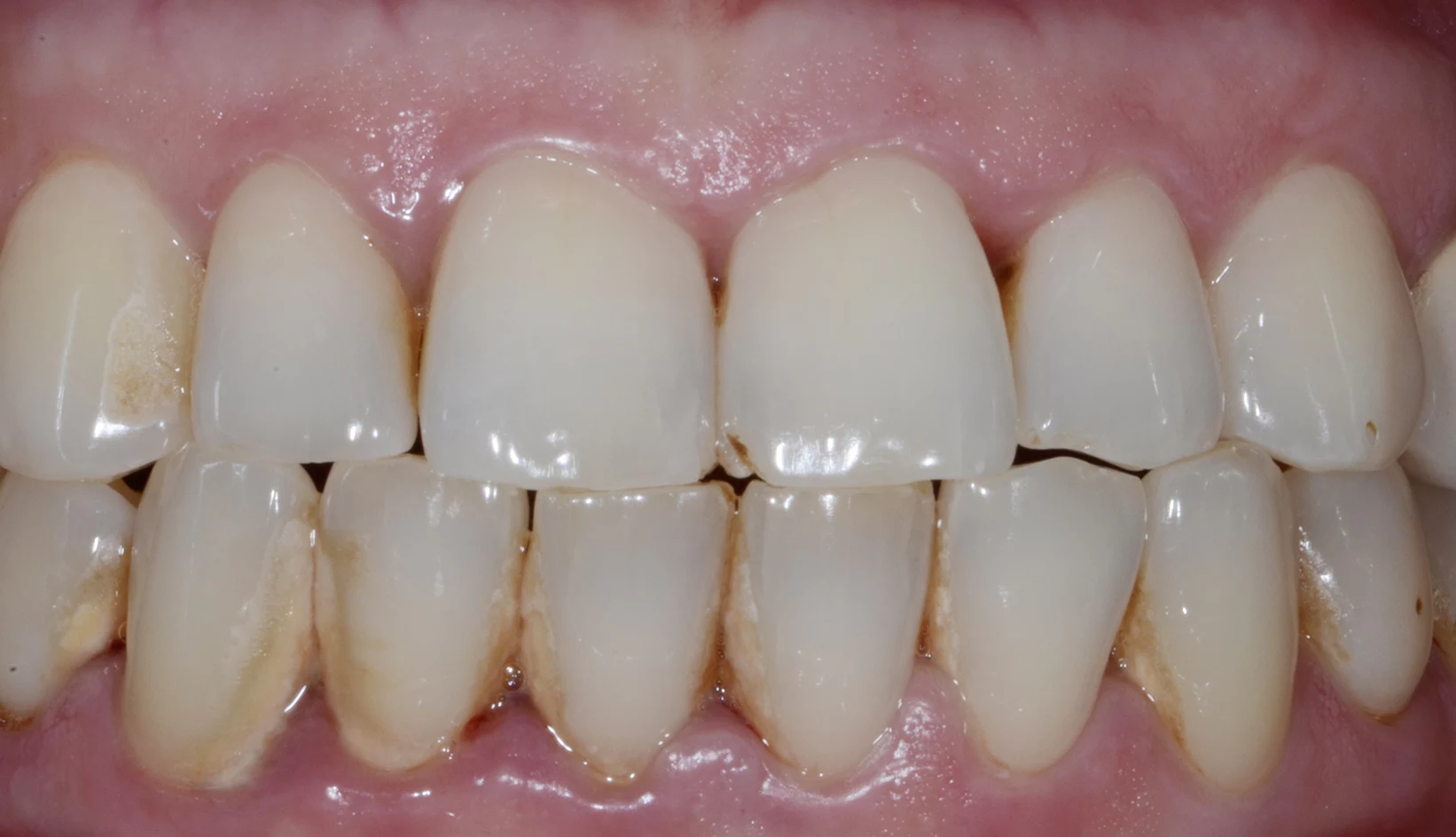 Igiene e Prevenzione Dentista Prato My-Dentity