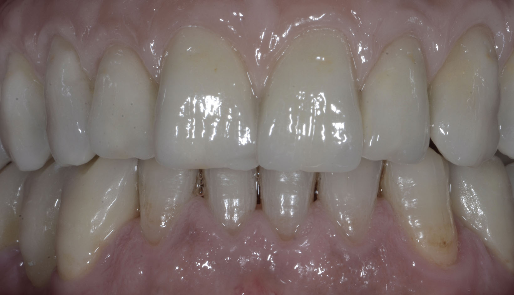 Protesi Additiva Dentista Prato My-Dentity