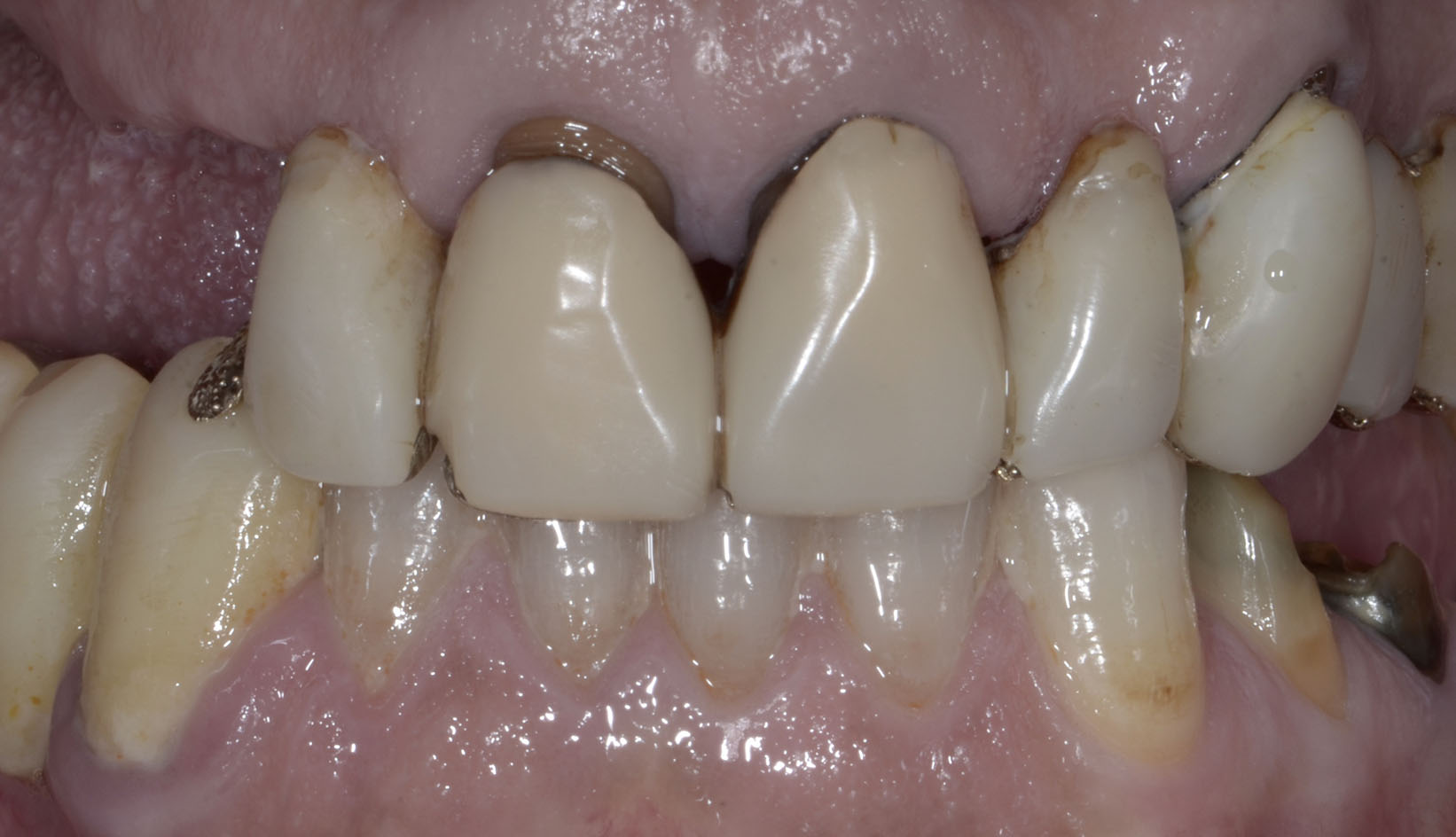 Protesi Additiva Dentista Prato My-Dentity